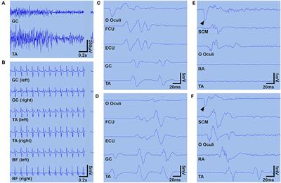 Case Report: Dexmedetomidine for Intractable Clusters of Myoclonic Jerks and Paroxysmal Sympathetic Hyperactivity in Progressive Encephalomyelitis With Rigidity and Myoclonus